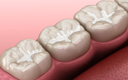 What Do Sealants Do for your Teeth?