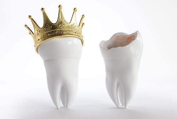 All About Crowns, Bridges & Fillings