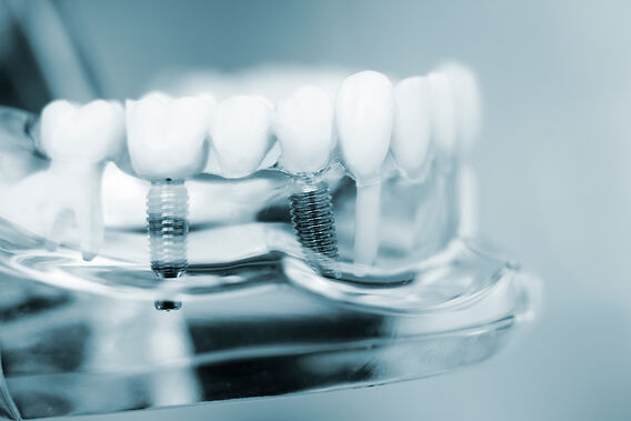 The Evolution of Dental Implants