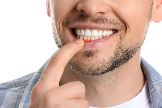Top Signs of Gum Disease