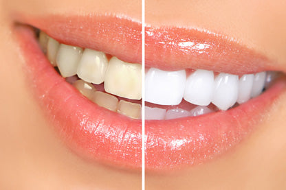How Professional Teeth Whitening Is Done
