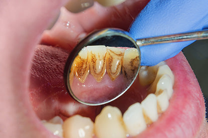 What Happens If You Don’t Brush Your Teeth