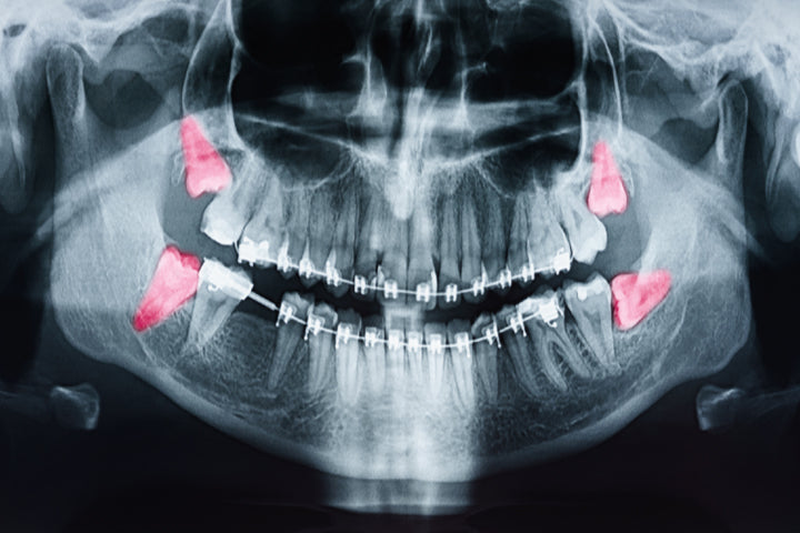 What to Expect With a Wisdom Tooth Extraction