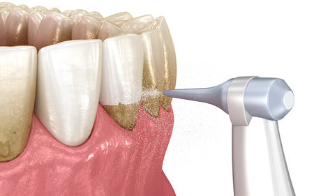 How to Prevent Tartar Build Up