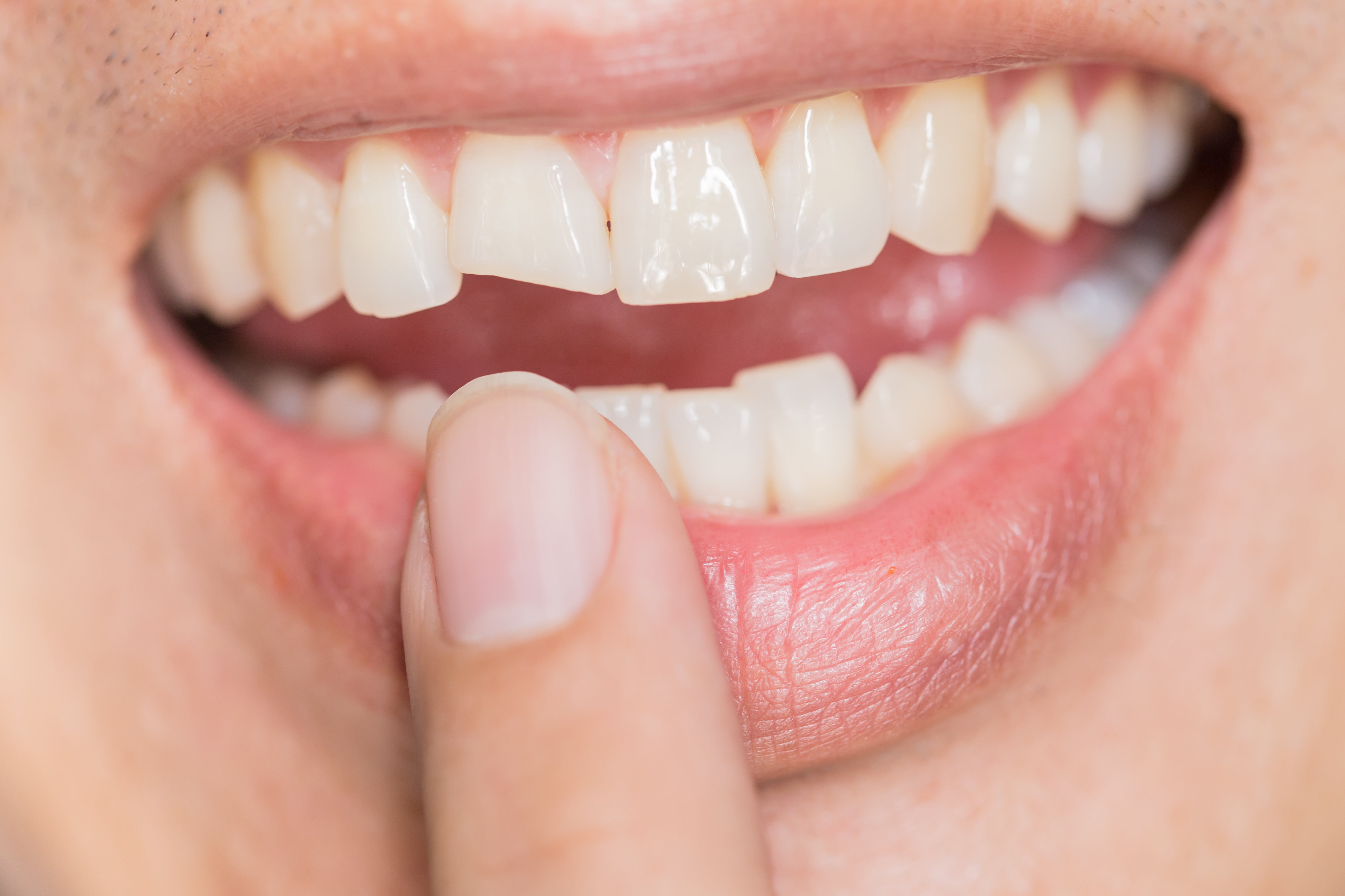 What to Do if Your Tooth Breaks