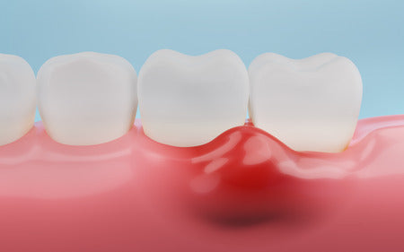 How to Get Rid of Gingivitis