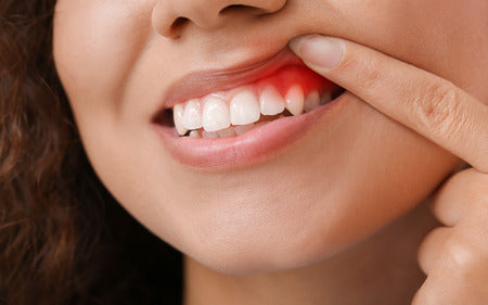 5 Signs of Gingivitis