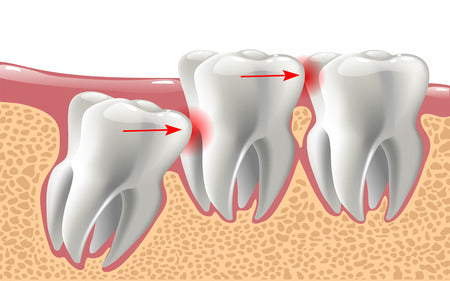 How To Know If Your Wisdom Teeth Are Coming In
