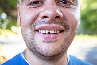 4 Ways A Dentist Will Fix Your Chipped Tooth