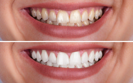 What’s the Best Way to Whiten My Teeth?