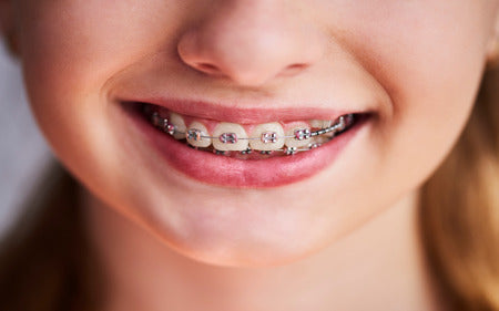 How Many Types of Braces Are There?