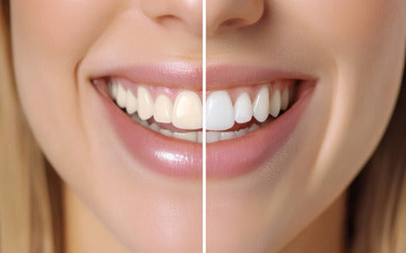 Teeth Whitening Options: What’s Right for You?