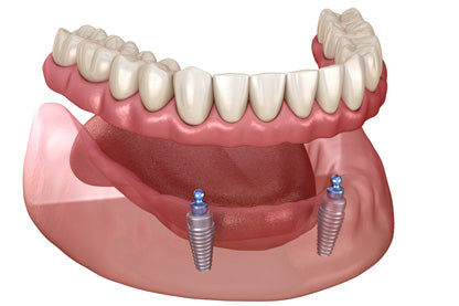 Dental implants vs dentures: Which is best for you?