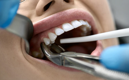 How Soon After Tooth Extraction Can You Have An Implant?
