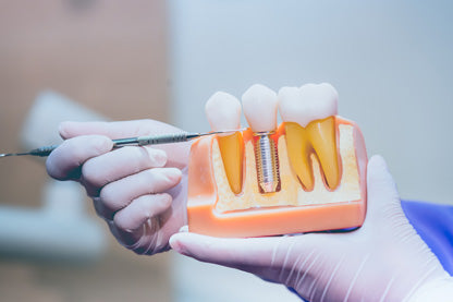 How Do Dental Implants Work and How Are They Made