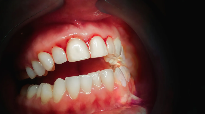 Bleeding Gums? Here’s What Your Mouth Is Trying to Tell You