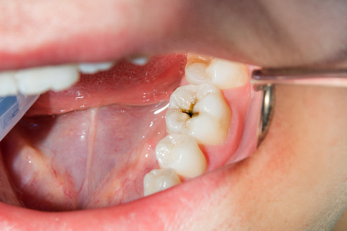 How Do Dentists Fill Cavities?