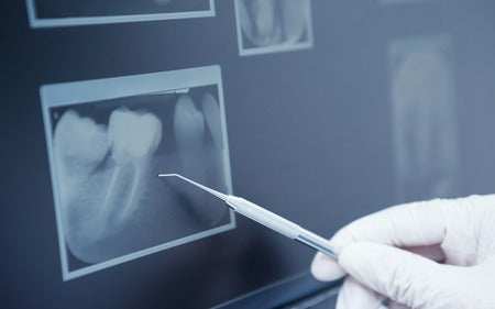 Are Dental X-Rays Safe and Needed?